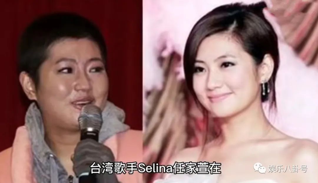 selina九年前谈及烧伤复健历程看哭了，selina眼眶中都是泪水